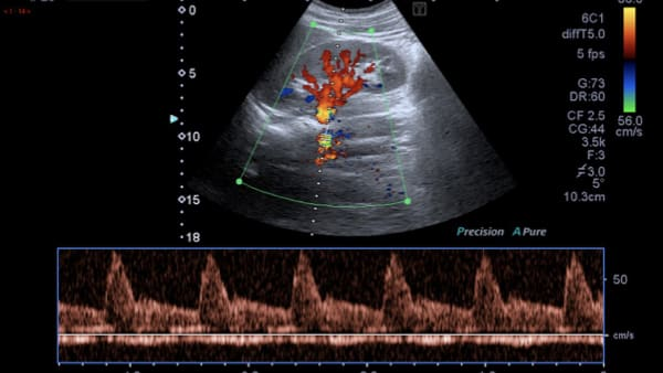 echographie doppler